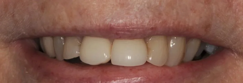 Before: upper front teeth of different shades, shapes and lengths