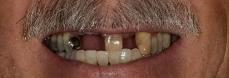 Before: missing teeth in a patient treated with head and neck radiation