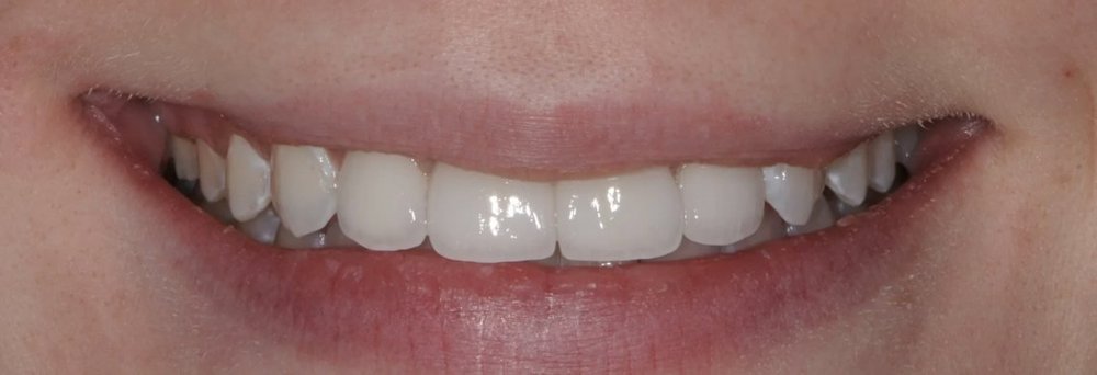 Upper front teeth after e.max crowns on the two central teeth and e.max porcelain veneers on the neighboring teeth