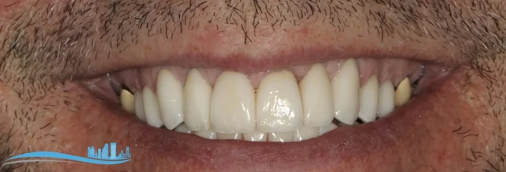 Upper front teeth after laser gingivectomy and layered e.max restorations