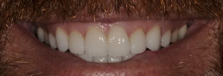 After: bright, even upper front teeth restored with veneers