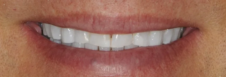 Before: upper teeth worn flat by bruxism