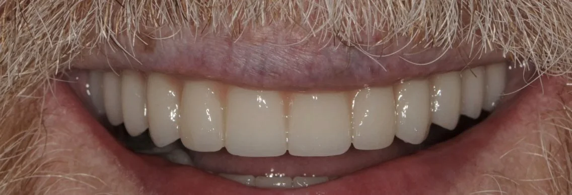 Fixed full-arch All-on-X implant dentures with zirconia teeth for a Jacksonville patient