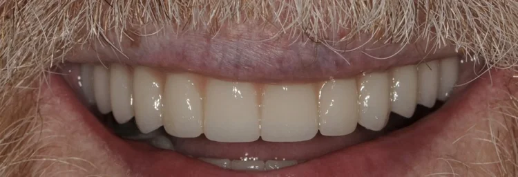 After: fixed full-arch zirconia teeth on six implants in each jaw