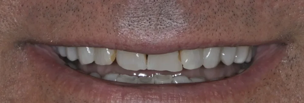 Before: chipped, uneven edges on the upper front teeth