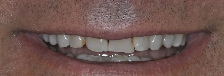 Before: chipped, uneven edges on the upper front teeth