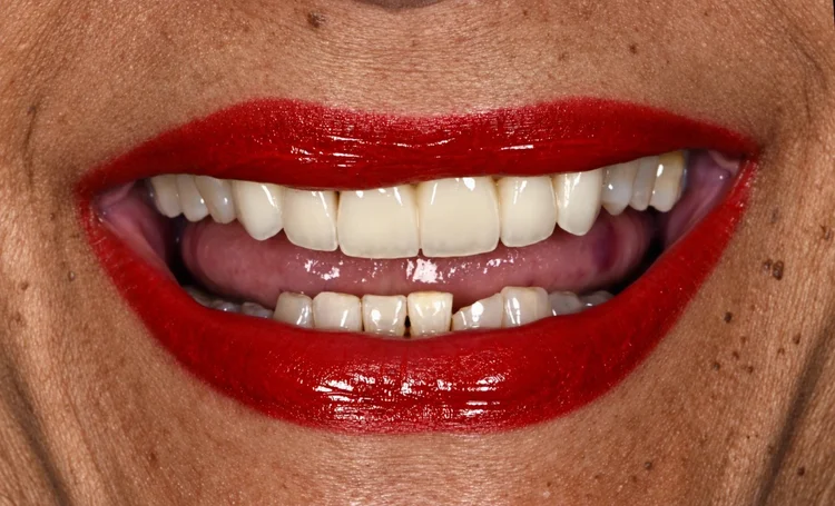 After treatment: even, natural-looking upper front teeth from canine to canine with a porcelain-fused-to-zirconia bridge and veneers