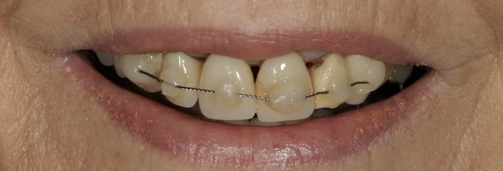 Before: upper front teeth damaged in a fall and held together with a wire splint