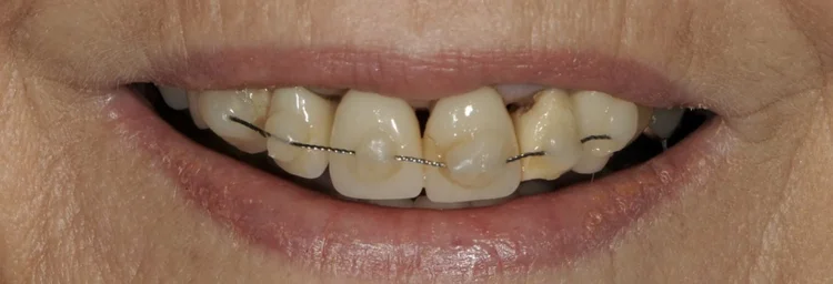Before: upper front teeth damaged in a fall and held with a wire splint