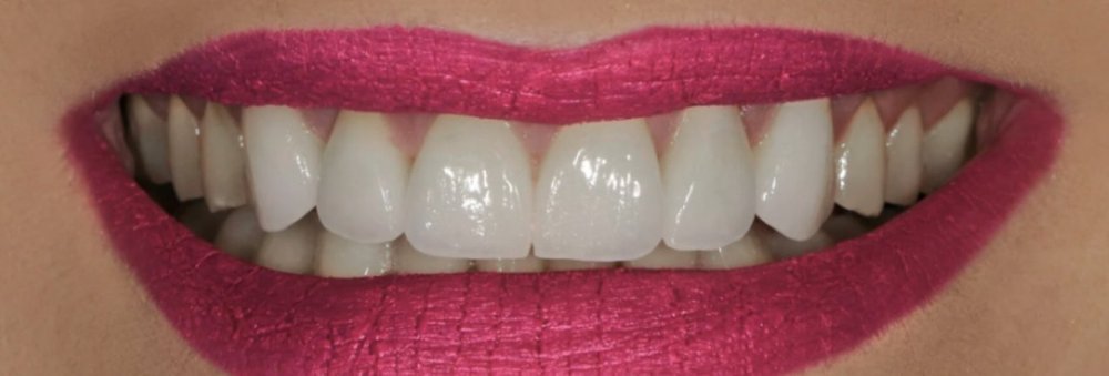After: e.max restorations restoring the length and shape of eroded front teeth