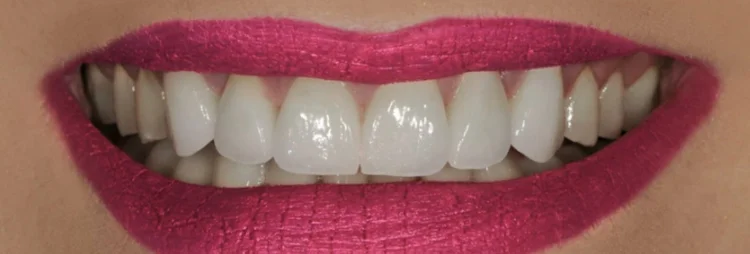 After: severely eroded upper front teeth restored with e.max crowns in Jacksonville