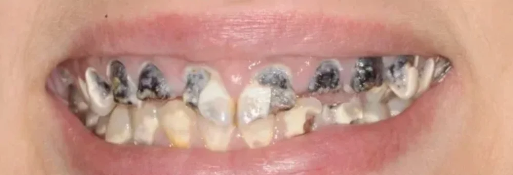Before: widespread decay across the upper teeth from soda consumption