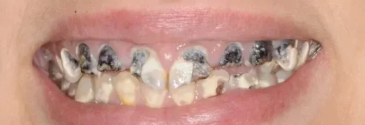 Before: widespread decay and missing teeth