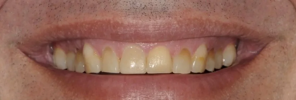 Before: upper teeth worn short and uneven from grinding