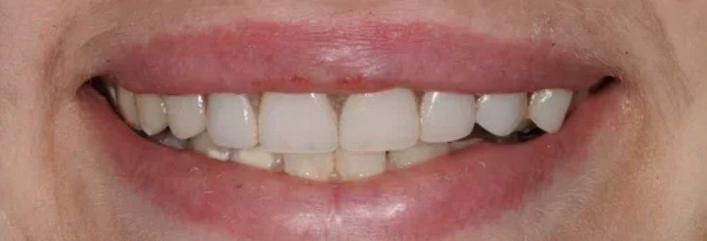After: natural-looking smile restored with composite restorations and a Valplast partial