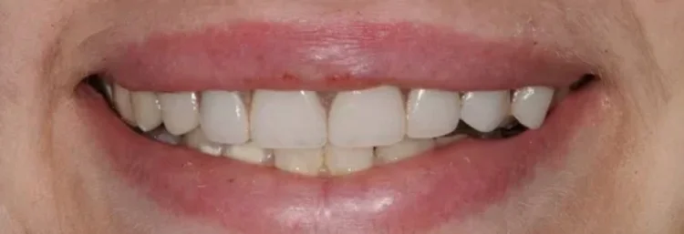 After: decay repaired and missing teeth replaced with a flexible partial denture