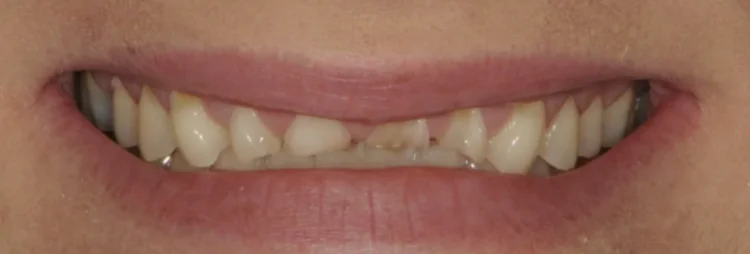 Before: upper front teeth severely worn by acid erosion