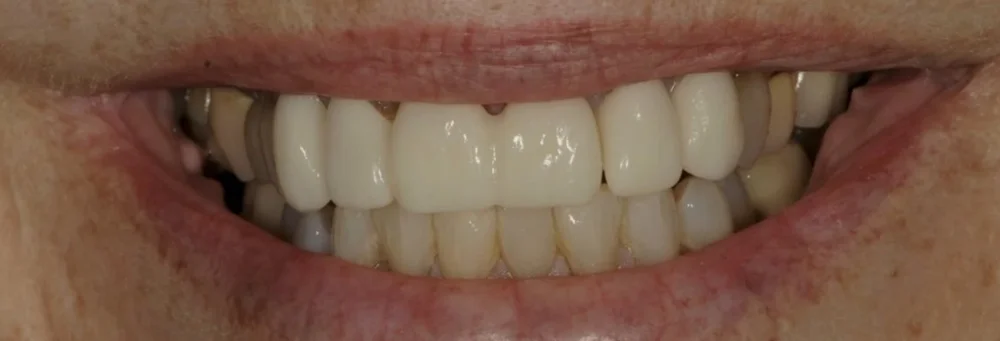 Upper front teeth before replacement of existing restorations that appeared bulky and opaque