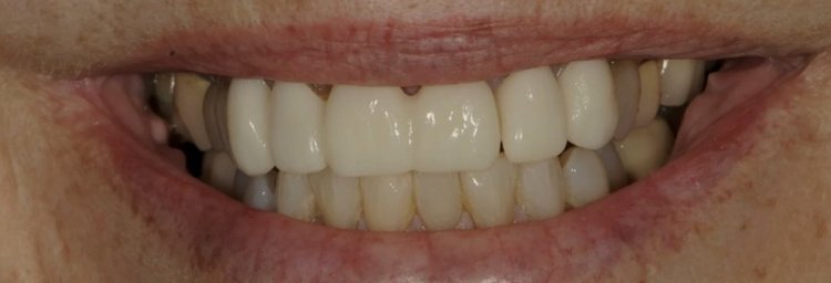 Before: bulky, opaque front restorations placed elsewhere