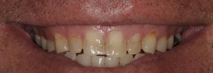 Before: upper front teeth with brown stain along the edges and uneven shades