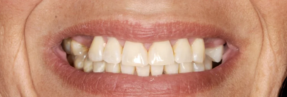 Before: worn, discolored, and uneven teeth