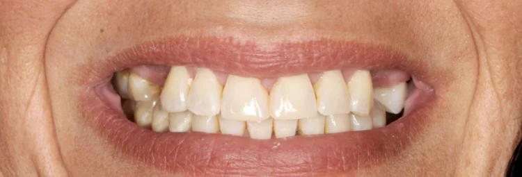 Before: worn, discolored, and uneven teeth