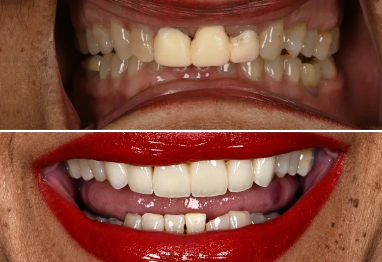 Before and after: fractured front tooth and old opaque crowns replaced with a porcelain-fused-to-zirconia bridge from #8 to #11, Jacksonville