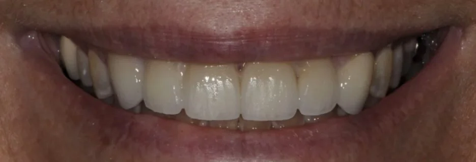 After: upper front teeth restored with veneers in one even shade