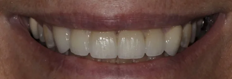 After: upper front teeth restored with veneers in one even shade