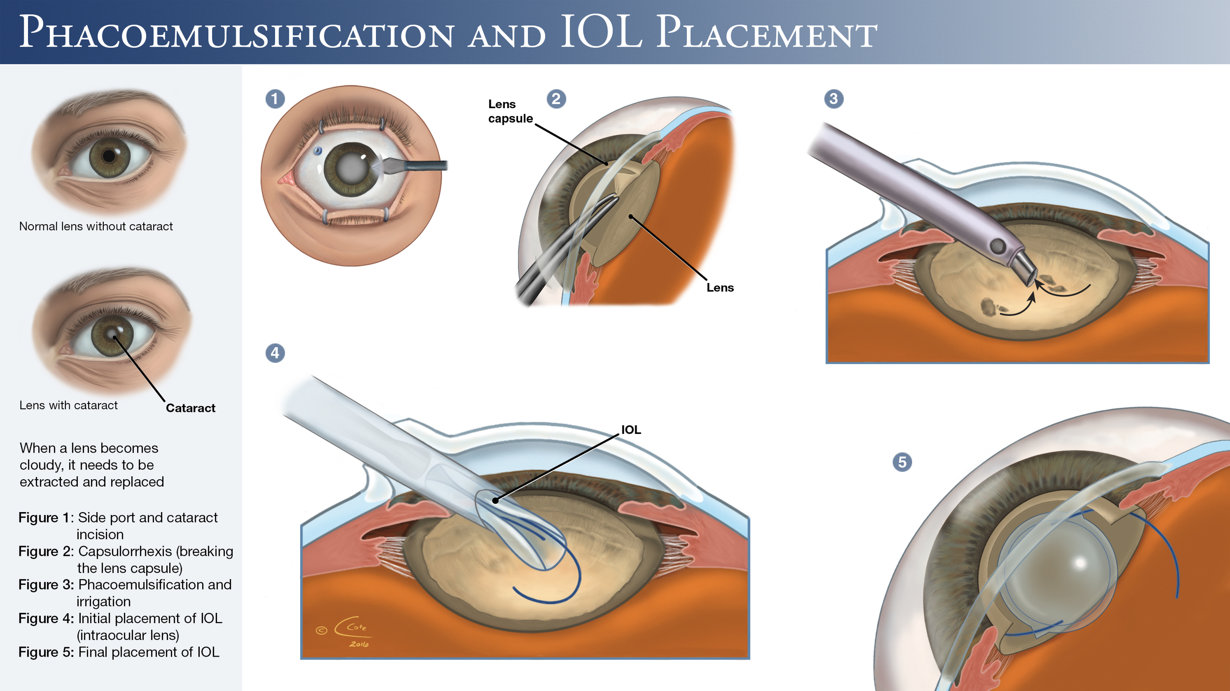 Когда после замены хрусталика восстанавливается зрение глаза. Факоэмульсификация катаракты с имплантацией интраокулярной линзы. Операция ультразвуковая факоэмульсификация катаракты. Катаракта операция с имплантацией ИОЛ. Факоэмульсификация катаракты этапы операции.