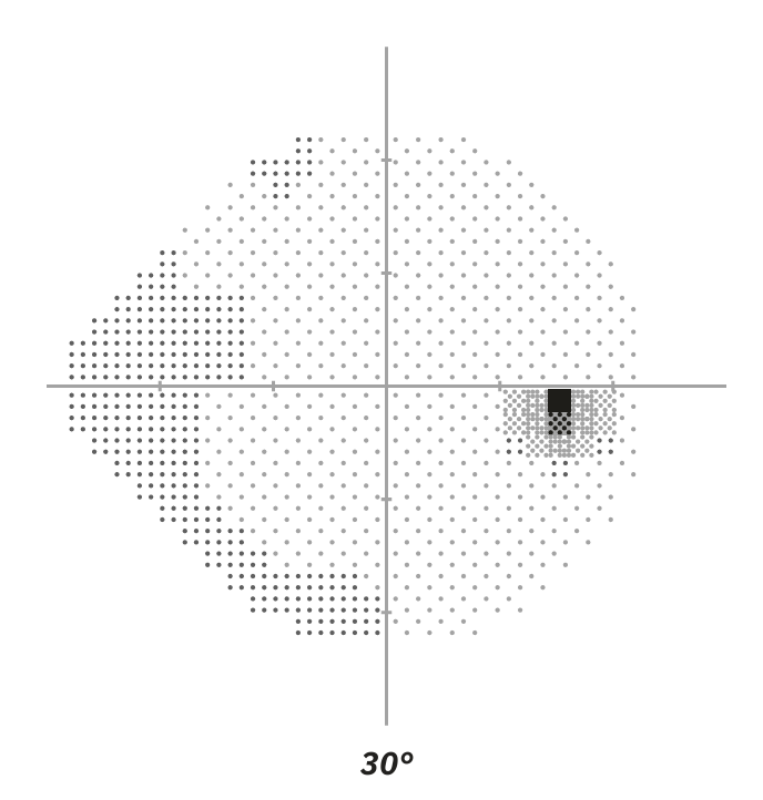 Visual field test