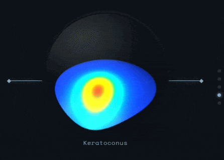 Corneal topography