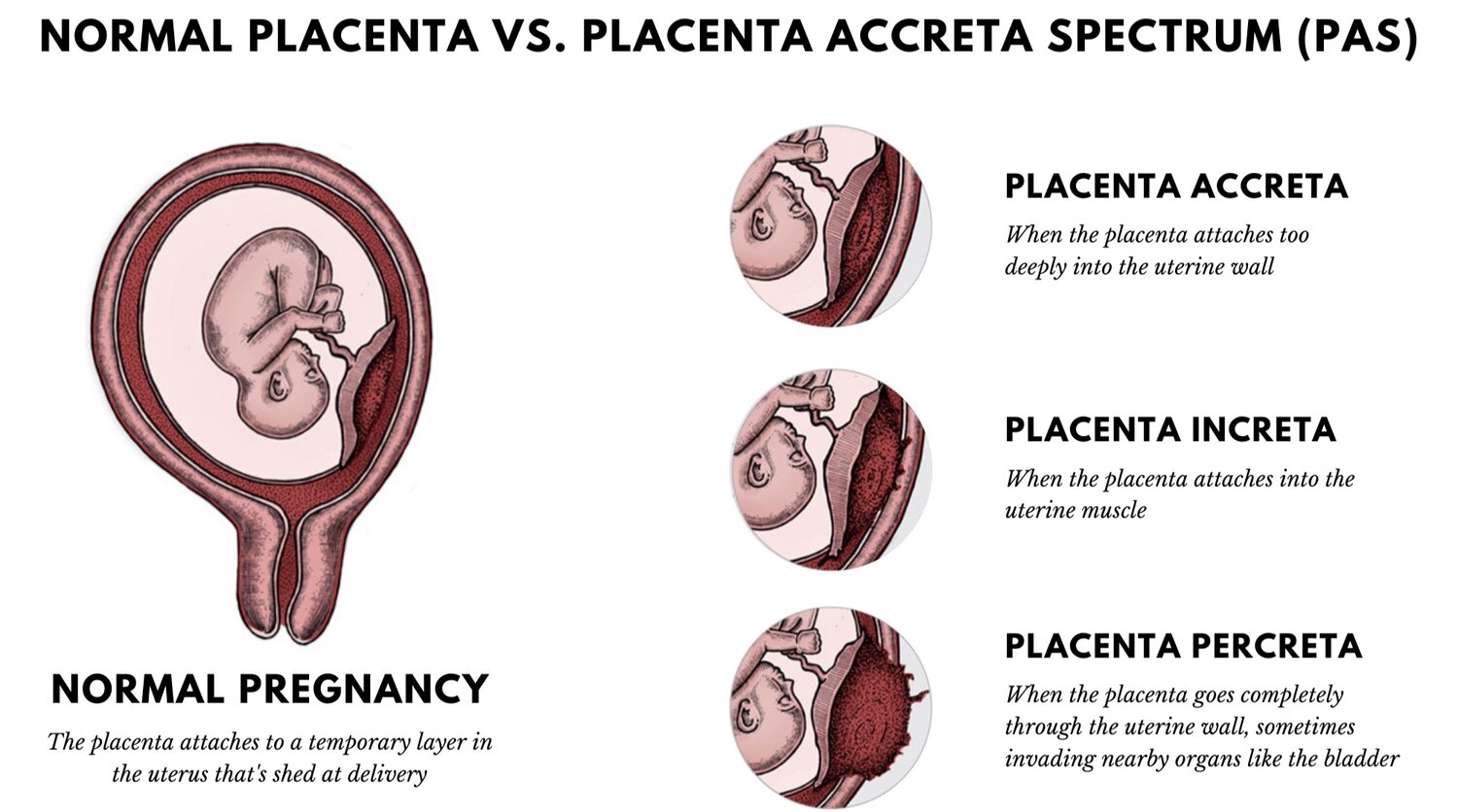 Плацента на рубце матки. Плацента Accreta increta percreta. Степени приращения плаценты. Патологическое прикрепление плаценты. Степени врастания плаценты.