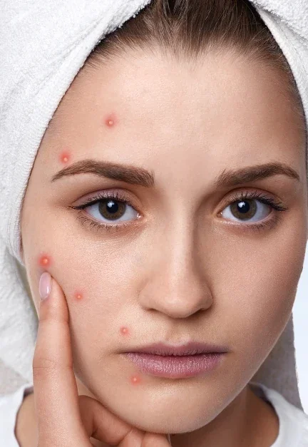 Deep cleansing facial for blackheads and clogged pores in Raleigh NC