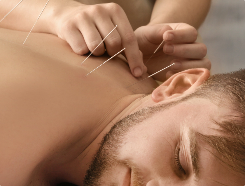 Acupuncture Image