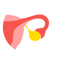 Ovarian Cancer