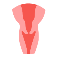 Cervical Cancer