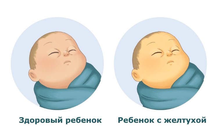 Как выглядит желтуха у детей Анализ крови на билирубин