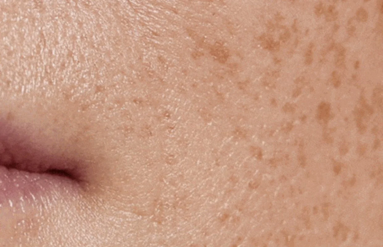 Wear Your Skin campaign