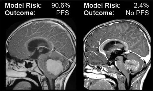 Two posterior fossa tumors with similar appearance on preoperative MRI, with the model's predictions