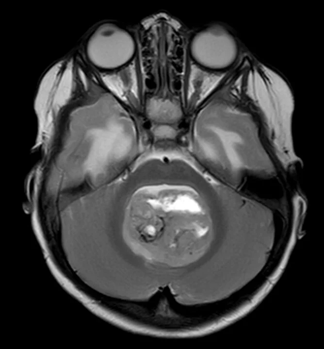 Preoperative MRI showing a tumor in the midline of the posterior fossa