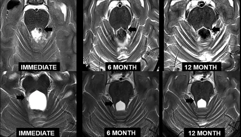 T2-weighted MRI showing bright signal in the superior cerebellar peduncles after surgery in two children with posterior fossa syndrome