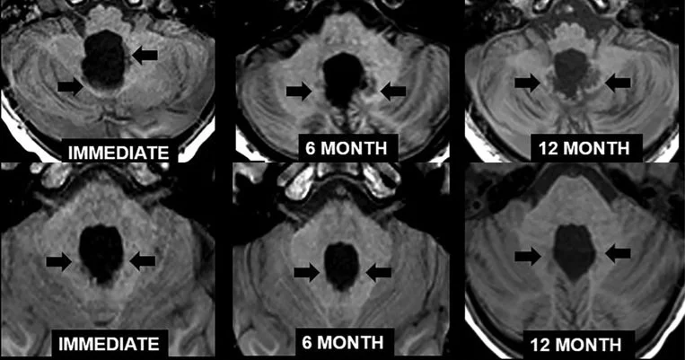 T1-weighted MRI showing bright signal in the dentate nuclei in children with posterior fossa syndrome (top row) compared with children without it (bottom row)