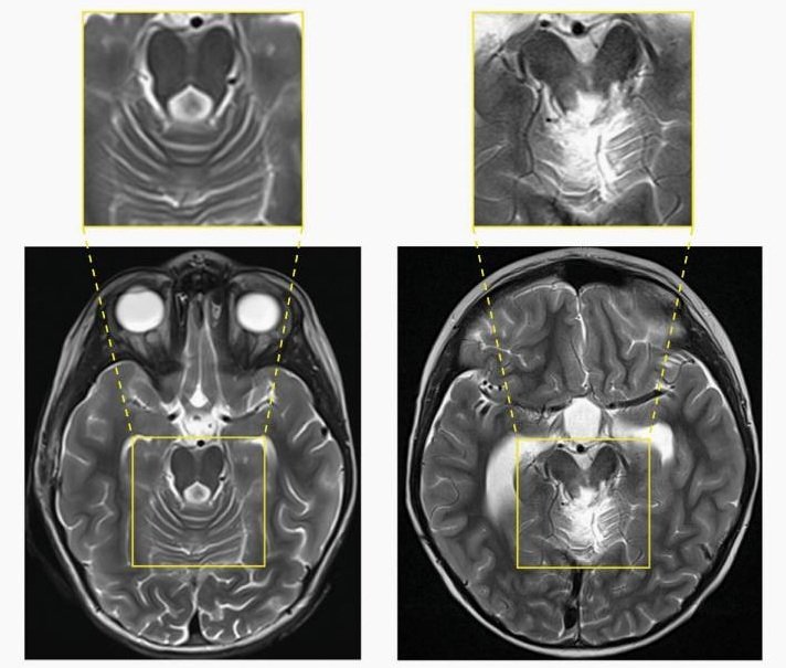 Postoperative MRI scans of two children after posterior fossa tumor surgery, side by side