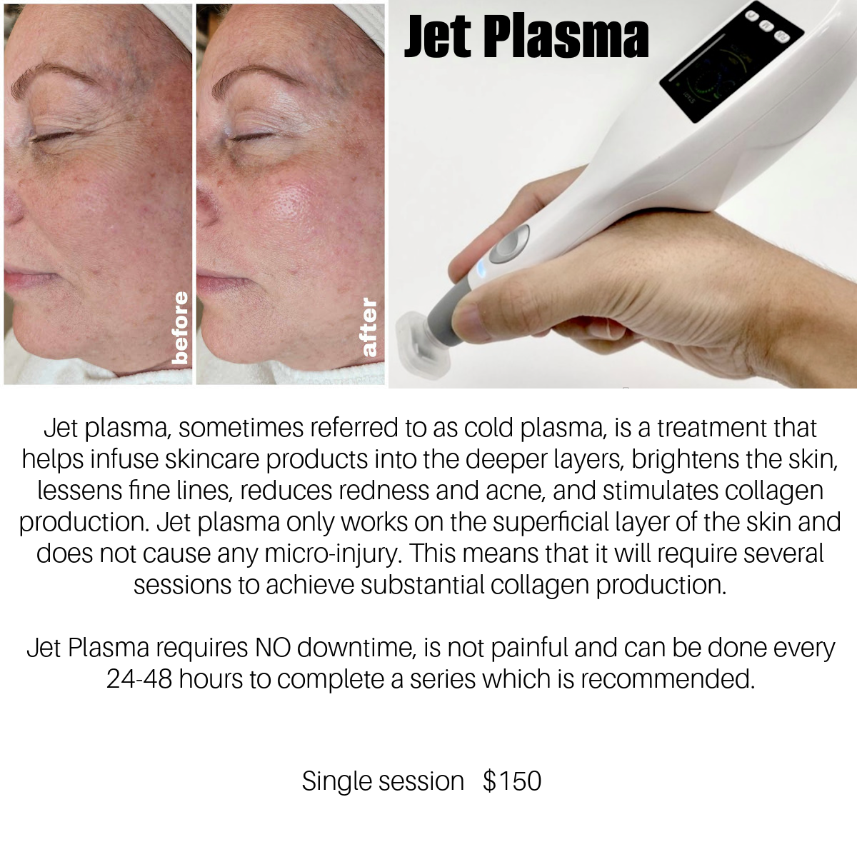 Jet, plasma, wrinkle reducing, eliminate wrinkles, fine lines, age spots