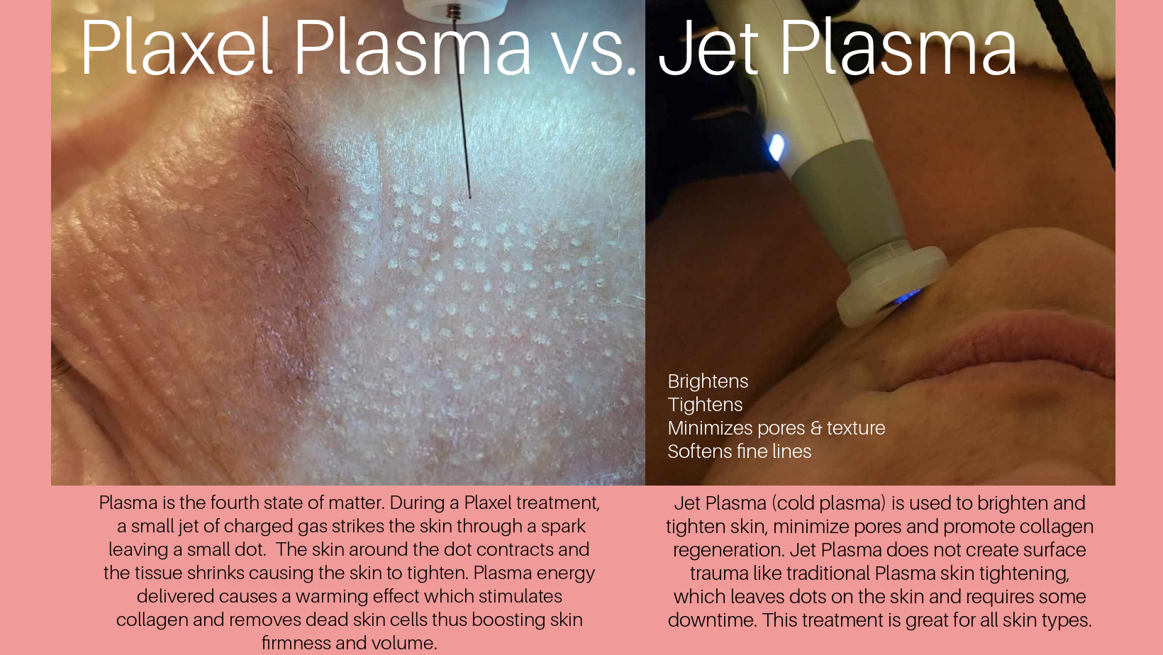 Jet, plasma, wrinkle reducing, eliminate wrinkles, fine lines, age spots