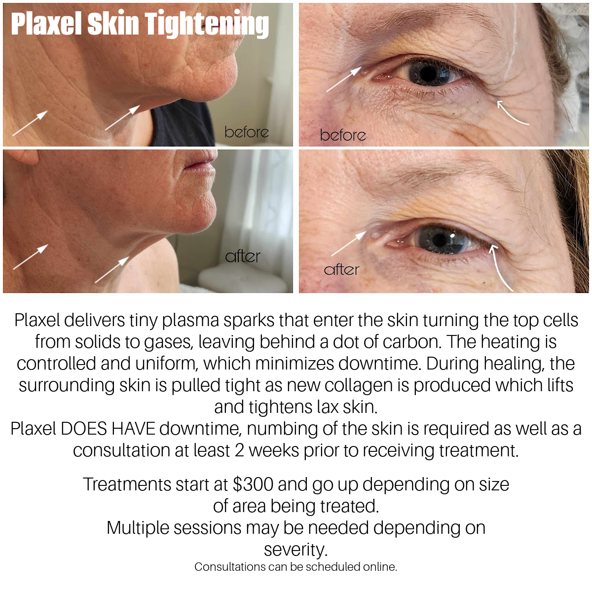 Jet, plasma, wrinkle reducing, eliminate wrinkles, fine lines, age spots