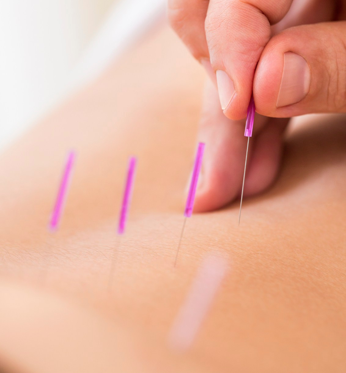 Dry needling treatment at Osteopractic Physical Therapy of the Carolinas in Fort Mill, SC