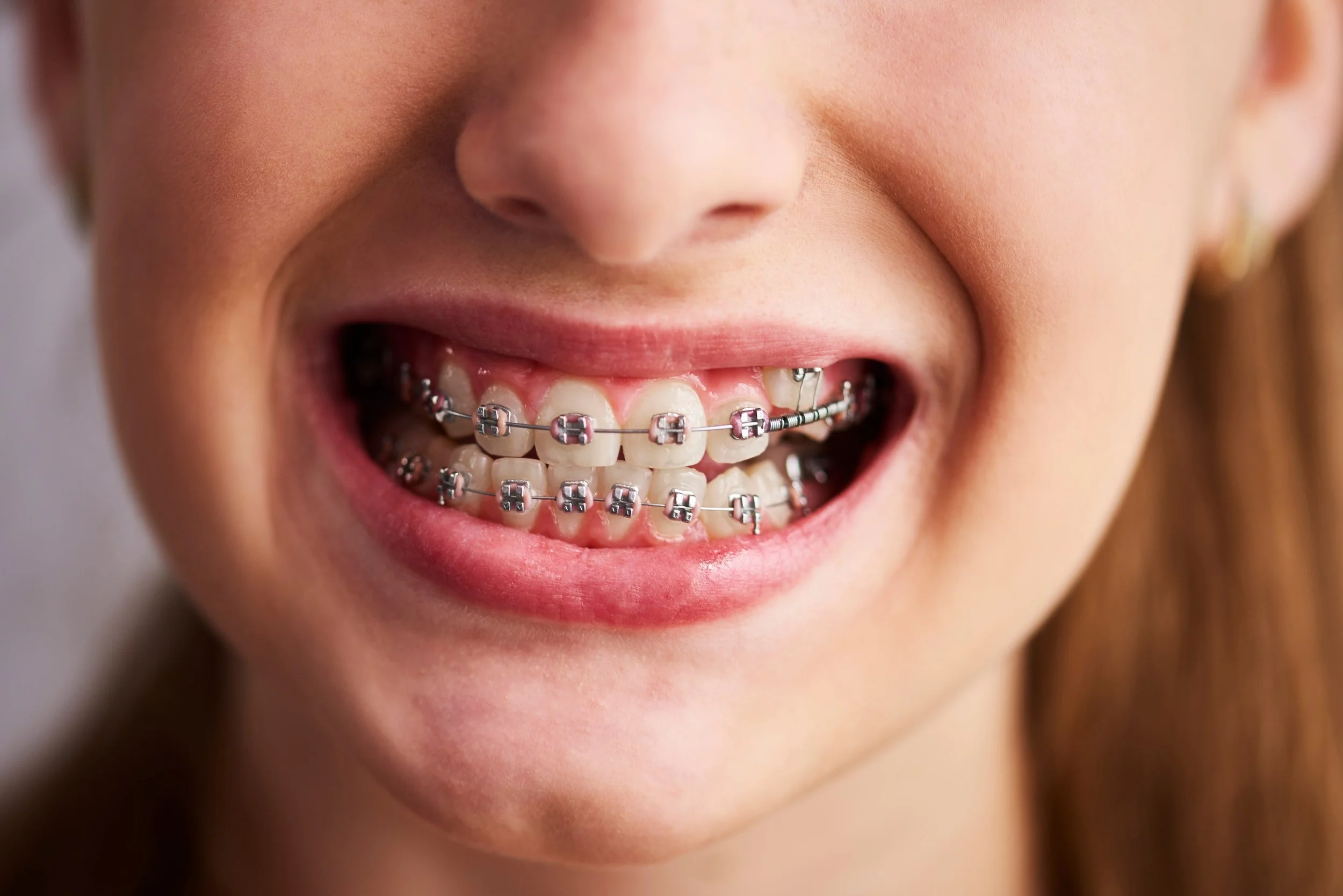 Traditional Metal Braces