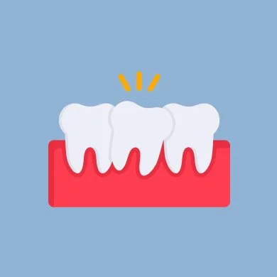 Overcrowded Teeth
